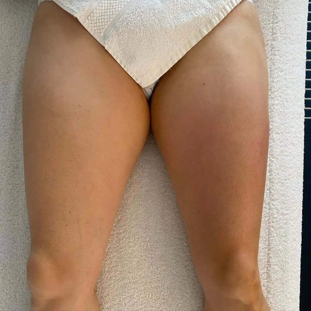 drainage-lymphatique-renata-franca-aix-en-provence-apres