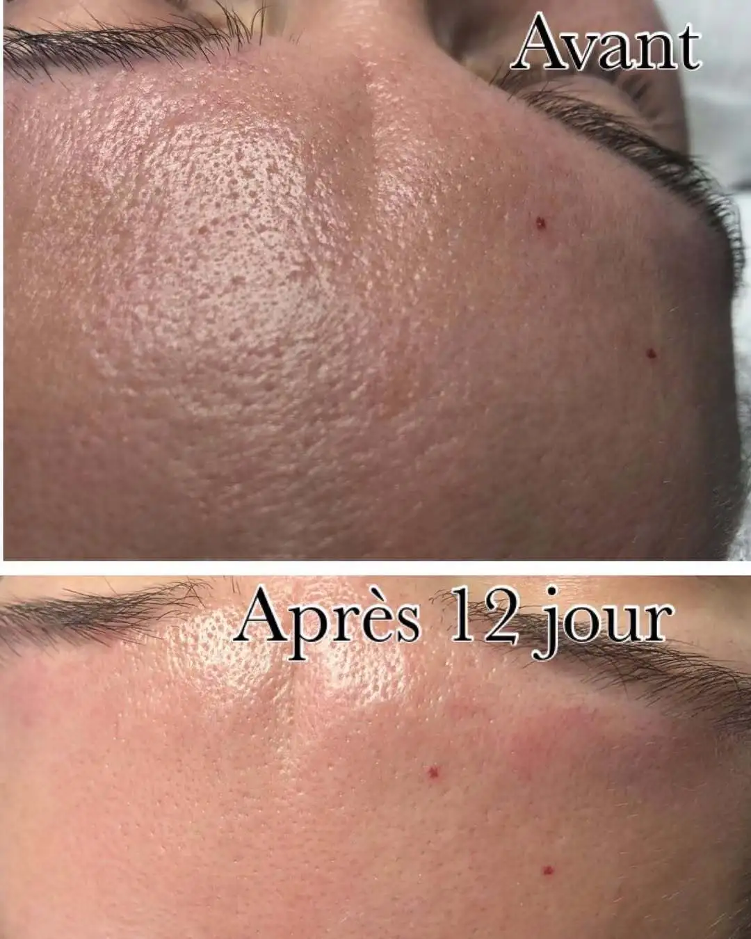 microneedling-aix-en-provence-avant-apres